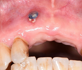 一例钛钉暴露的块状骨移植