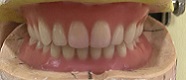 儿童全口总义齿修复一例