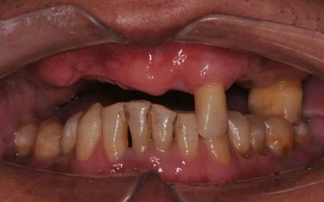 上頜牙列缺失種植固定全瓷修復一例
