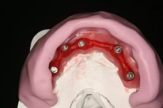 上頜牙列缺失種植固定全瓷修復一例