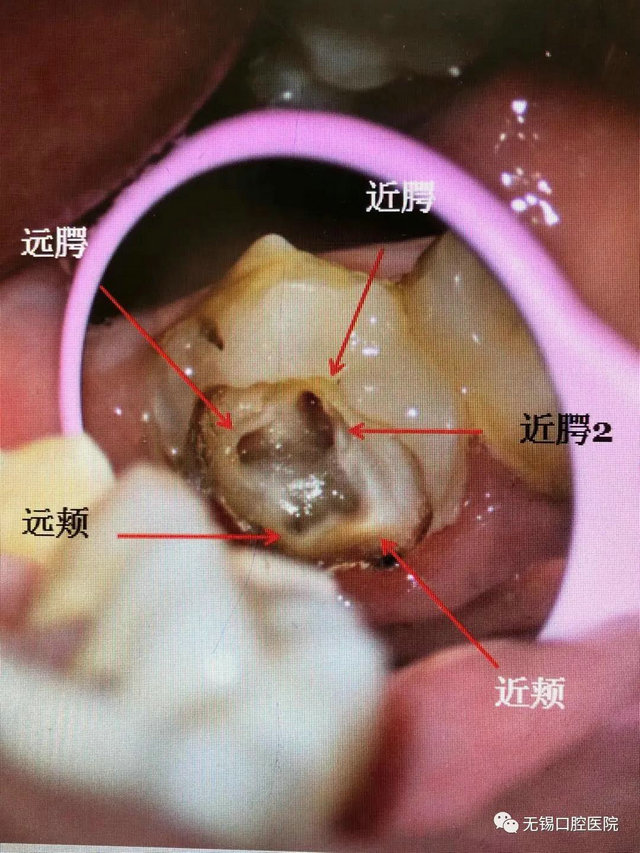 牙髓变性图片