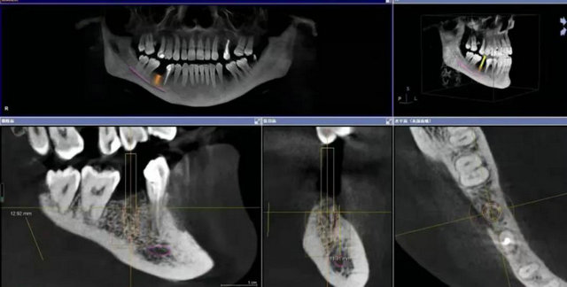 術前ct及種植牙模擬設計