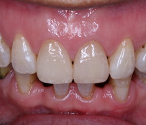 一例前牙死髓牙内漂白后的瓷贴面修复