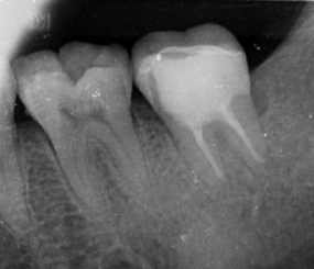 下颌第二磨牙根管治疗联合龈壁提升术后覆盖嵌体修复一例