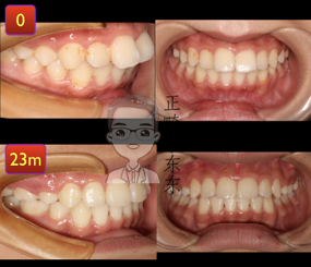 14期，龅牙 嘴突，拔牙加骨钉，矫正送下巴