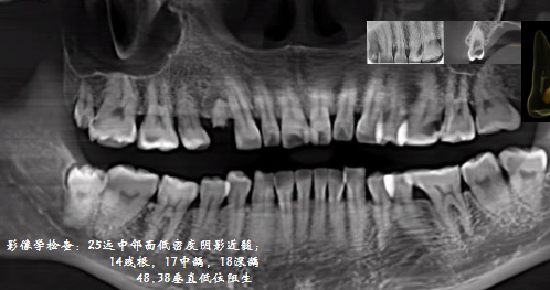 我的2023—左上前磨牙根管治疗后全冠修复一例