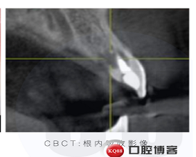 如何设计美学区种植穿龈轮廓实现龈缘冠向爬行